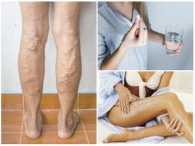 Vene varicose sulle gambe e metodi di trattamento