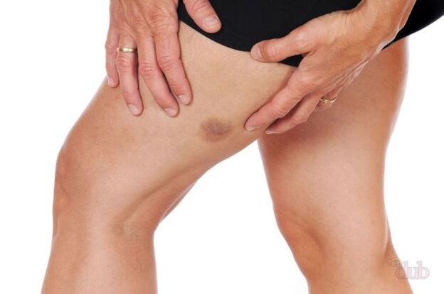 quando scoppia una vena