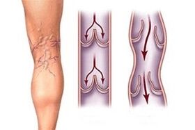 Scarico di sangue nelle vene varicose in diversi stadi di sviluppo della malattia